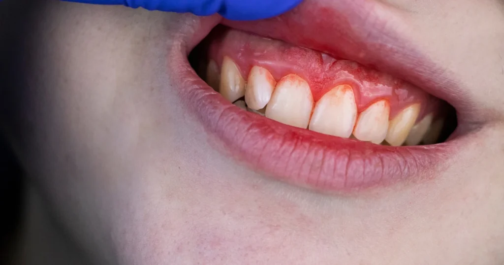 Limpieza Dental Profunda en Estelí para Eliminar el Sarro y Sangrado 1