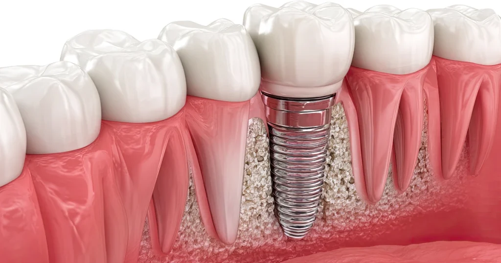Recupera tu Capacidad de Comer y Sonreír con Implantes Dentales en Estelí