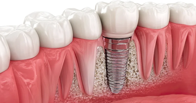Recupera tu Capacidad de Comer y Sonreír con Implantes Dentales en Estelí