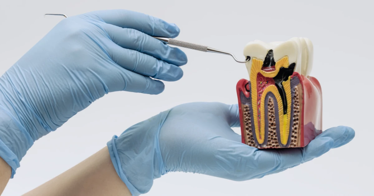 Tratamiento de Endodoncia en Estelí para Eliminar el Dolor y Salvar tu Diente 1